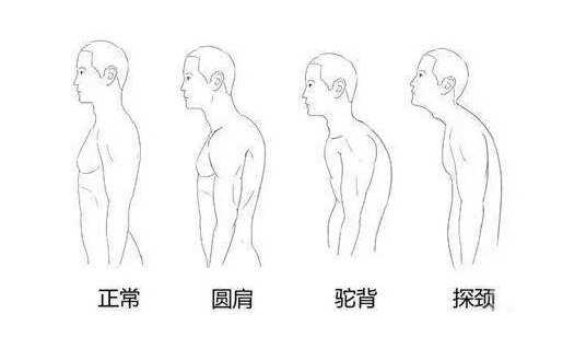 驼背圆肩探颈